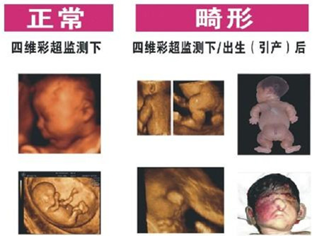 怀孕晚期四维彩超检查情况?