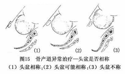 分娩常识之什么是产道异常?