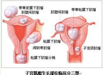 患了子宫肌瘤痛不痛