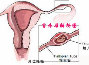 宫外孕显著的症状