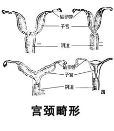 宫颈畸形症状