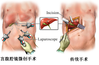 宫腹腔镜手术与传统手术比较