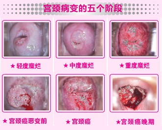 宫颈糜烂的图例解析