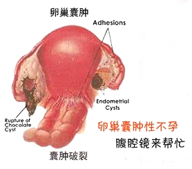 得了卵巢囊肿怎么办?卵巢囊肿患者饮食注意事项