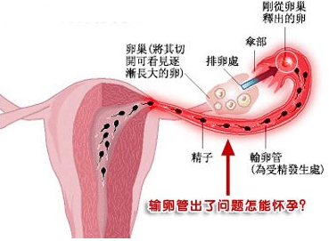 腹腔镜微创治疗输卵管粘连