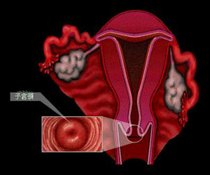 您不知道的子宫颈炎的危害