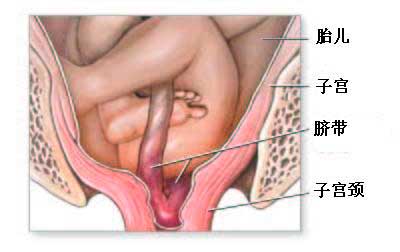 什么叫脐带脱垂?永州妈妈如何预防脐带脱垂?