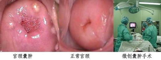  女性患了宫颈囊肿后可以同房吗