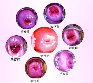 leep治疗宫颈糜烂的效果