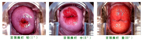 病理解剖：宫颈糜烂的分型