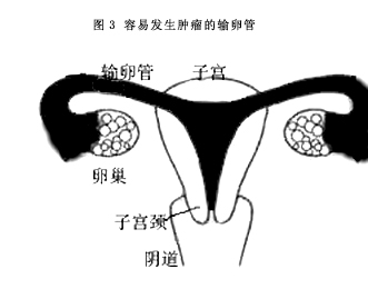 输卵管肿瘤可引起不孕吗?如何预防输卵管肿瘤