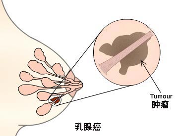 乳腺癌早期症状及注意事项