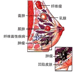 10类易发生乳腺癌的人群，您是否位例其中