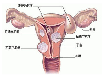 永州哪家医院治疗子宫肌瘤好?